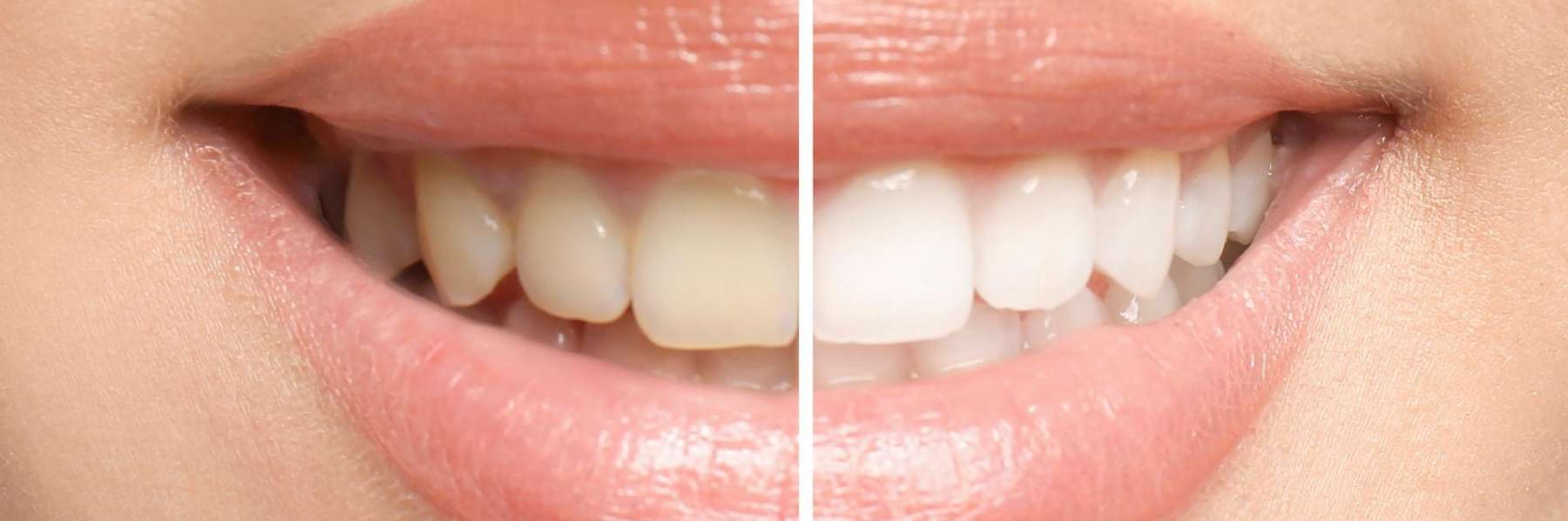 A side by side Teeth whitening result in Pacifica, CA