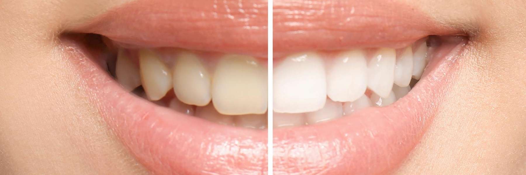 Exploring the Best Cosmetic Dentistry Solutions in Pacifica, CA