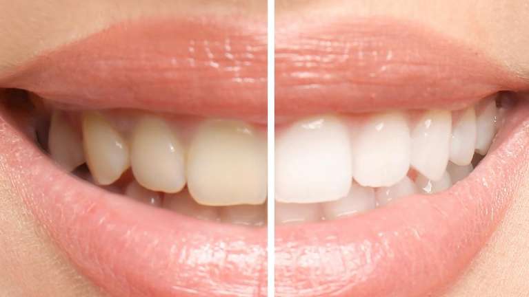 A patient after a teeth whitening treatment in Pacifica, CA