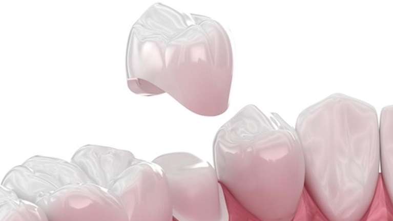 An image depicting dental crown in Pacifica, CA