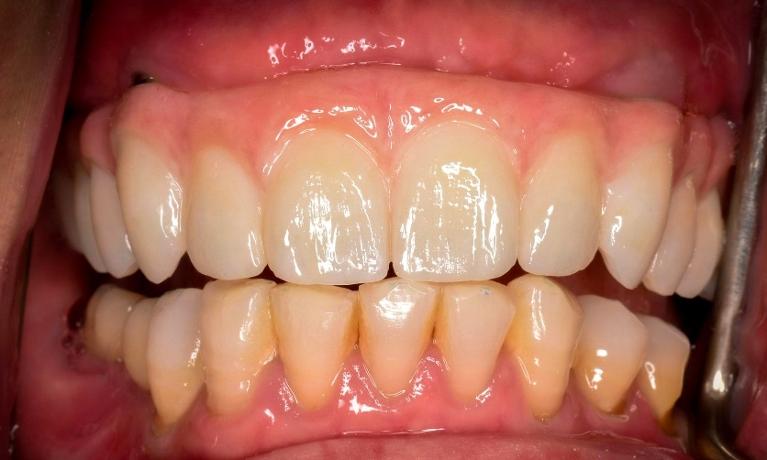 Patient after removing damaged teeth and receiving dental implants in Pacifica, CA