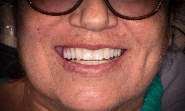 patient after receiving dental implants