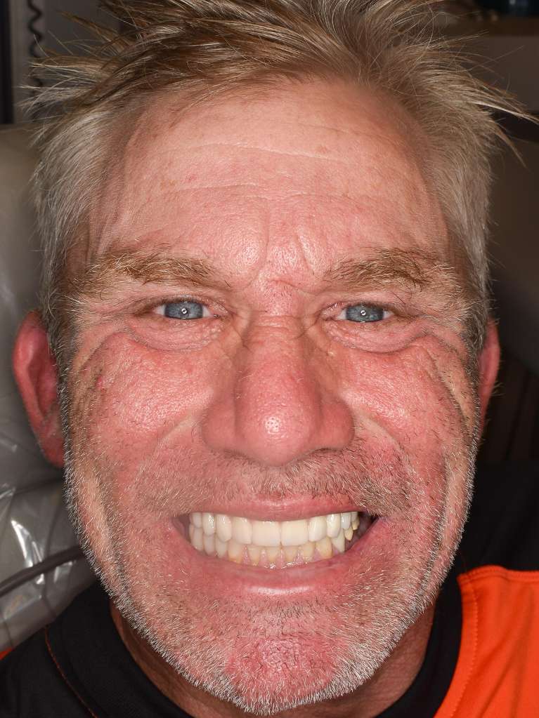 An after image of a man smiling after getting dental implants in Pacifica, CA
