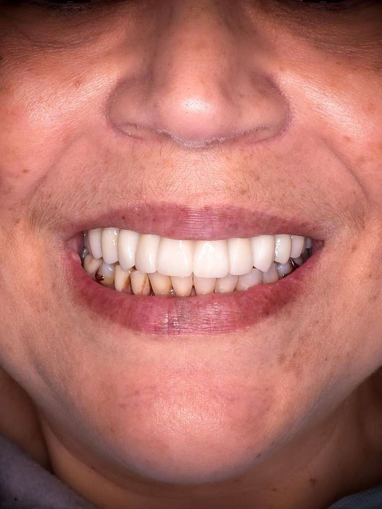 Patient after receiving Dental Implants