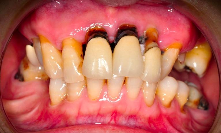 Patient with an untreatable oral condition