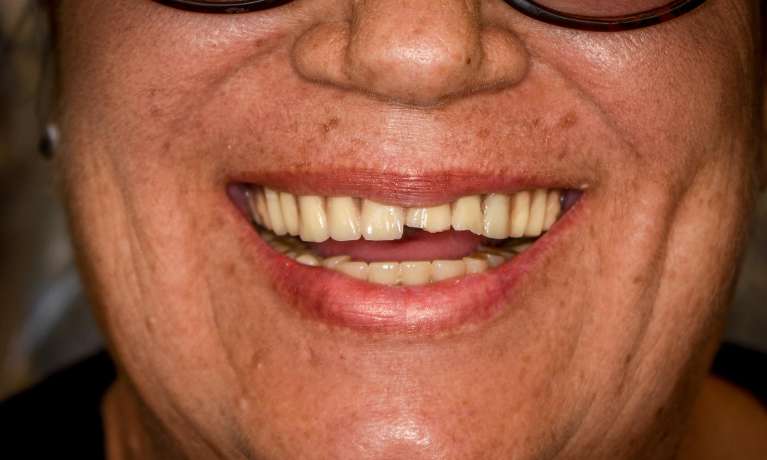 Before photo of patient tired of dentures