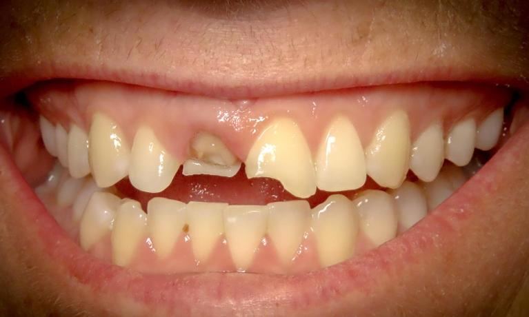 How-to-Rebuild-a-Broken-Smile-Before-Image