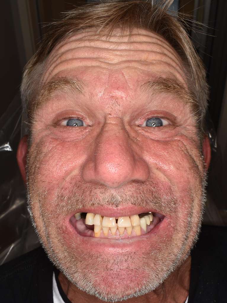 A man smiling before getting dental implant in Pacifica, CA