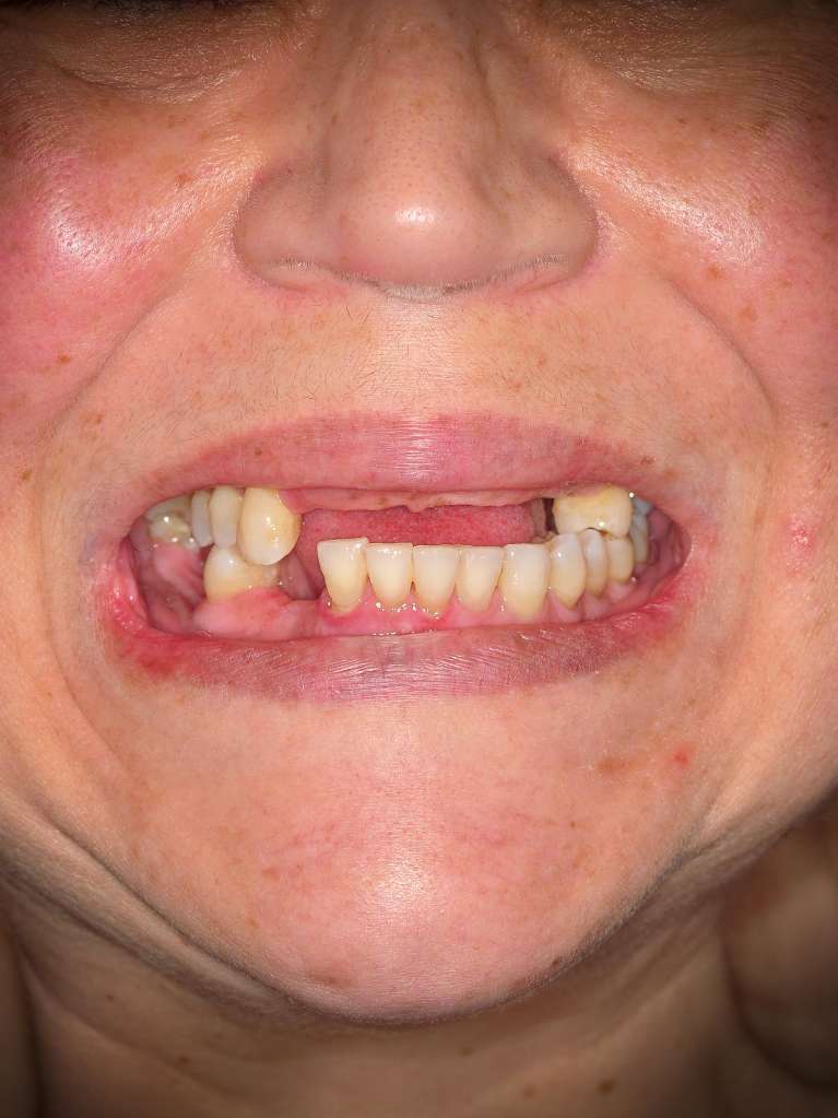 Patient Before Dental Implants