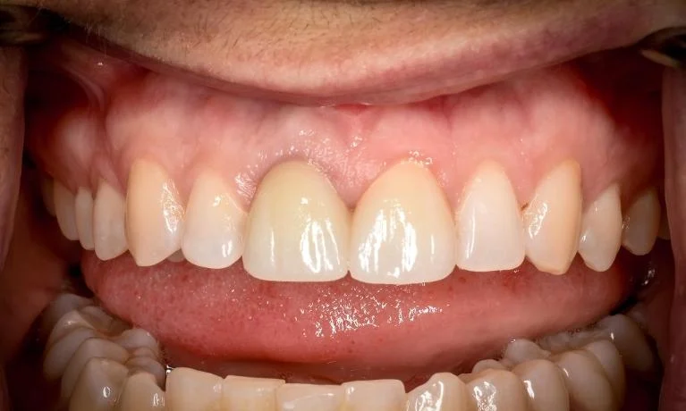 After treatment at Cabrillo Family Dental Care