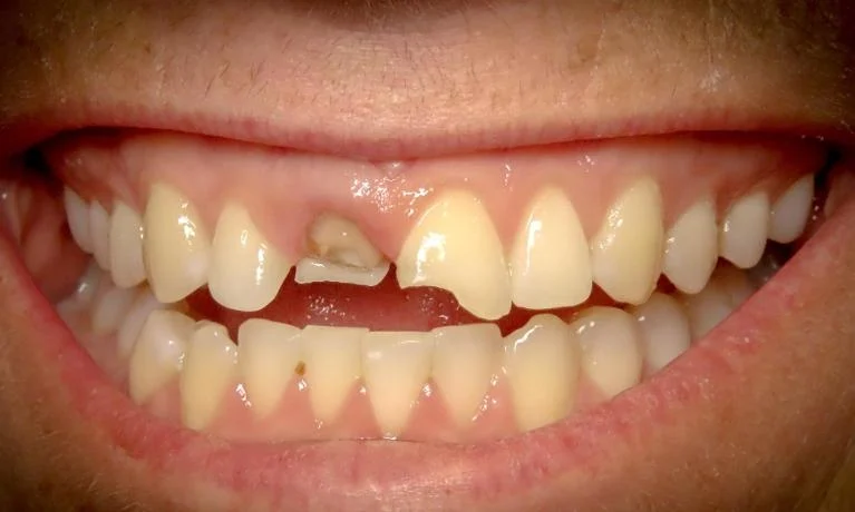 Before treatment at Cabrillo Family Dental Care