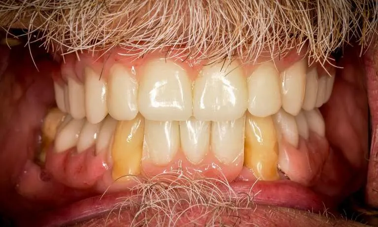 Image after implant treatment at Cabrillo Family Dental Care