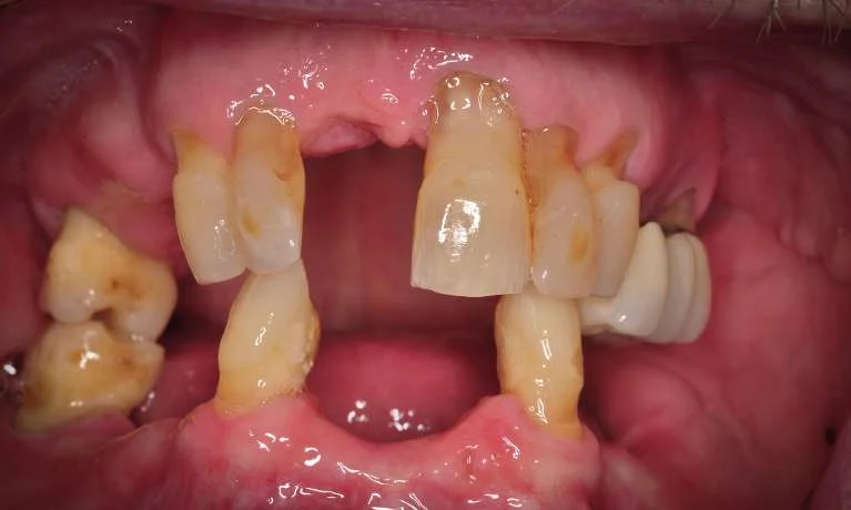 Image before implant treatment at Cabrillo Family Dental Care