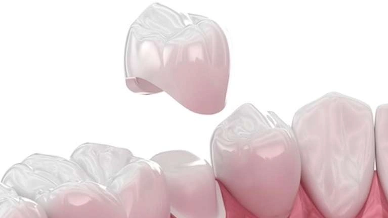 Illustration of a dental crown