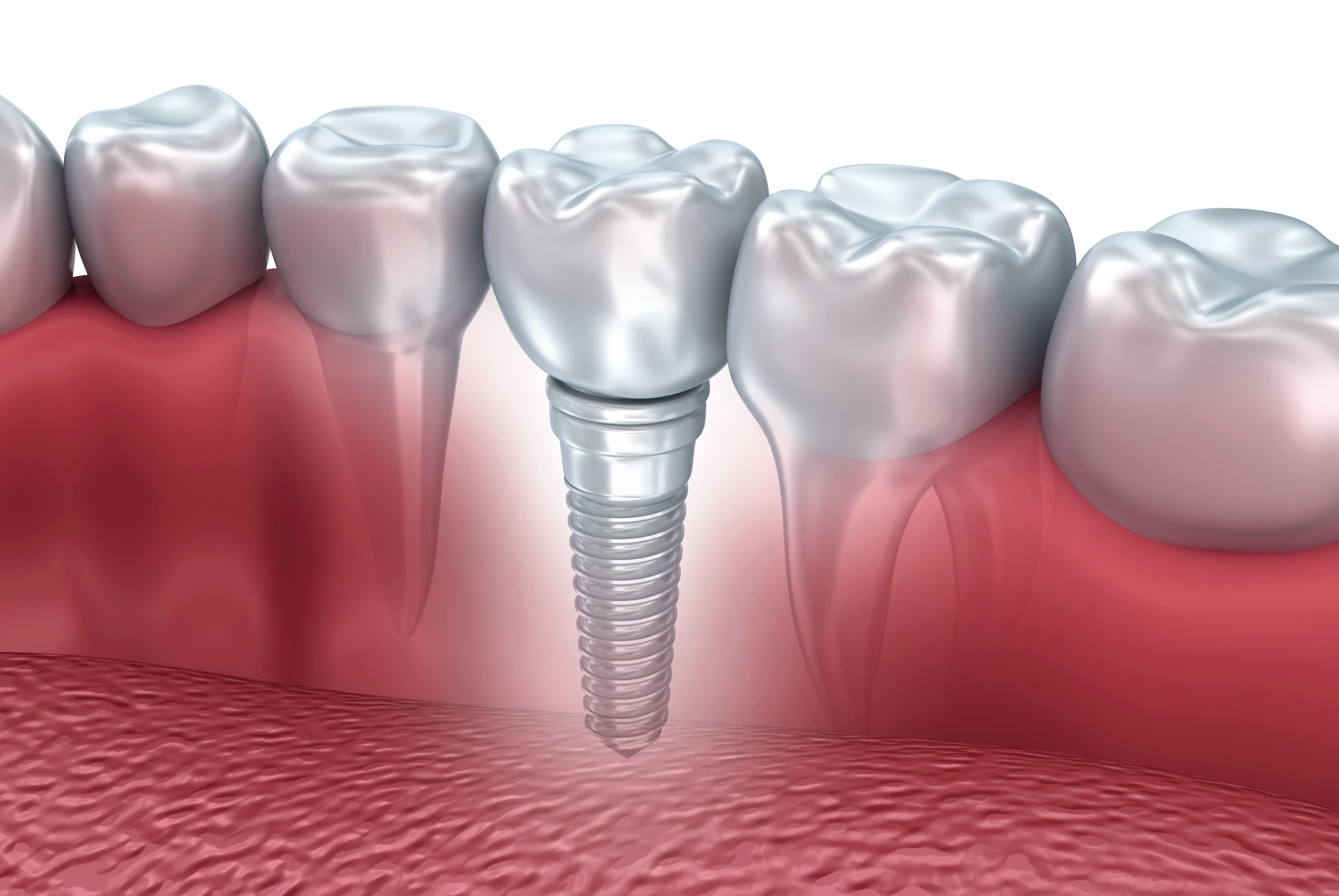 Illustration of dental implant