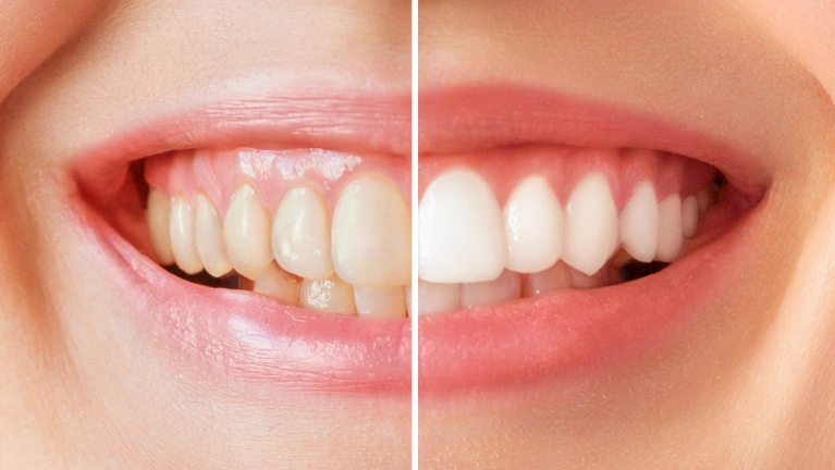 Before and after teeth whitening treatment