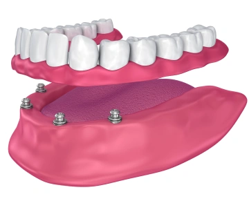 Model of dentures