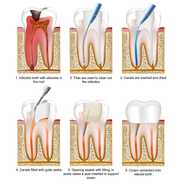 Illustration of root canal