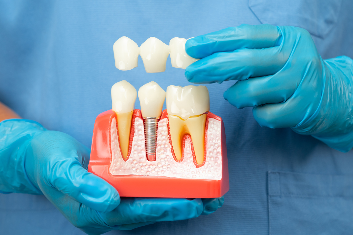 Dental Implants Can Restore Your Smile