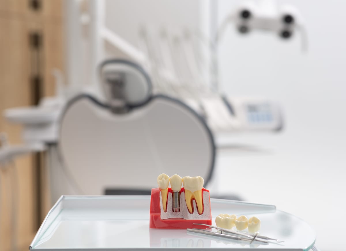 Dental Implants in Pacifica