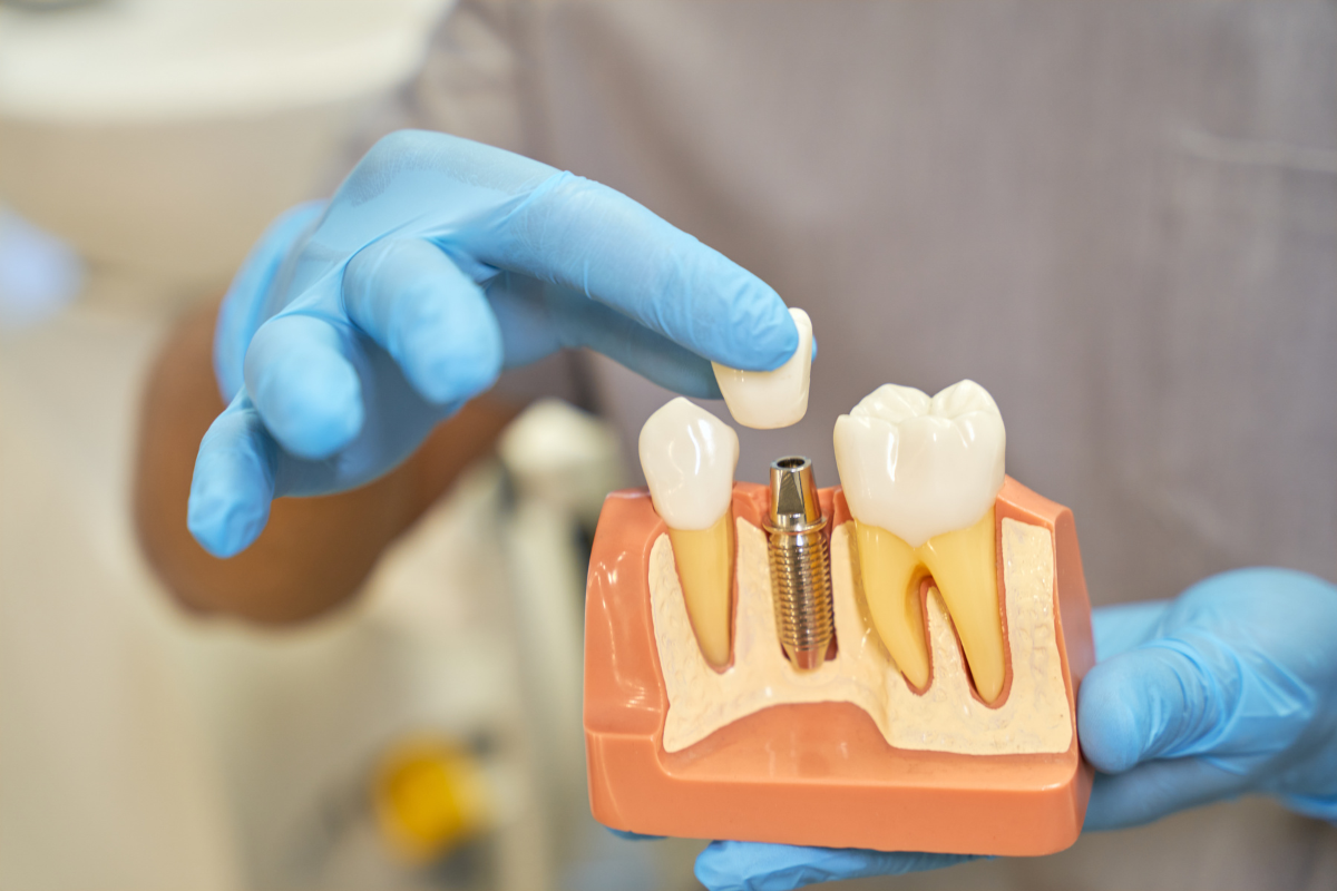 Advanced Tooth Replacement Process